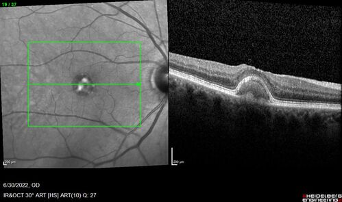 Pattern Dystrophy with Collapsed Vitelliform
74 year old female with vision loss in eye with collapsed vitelliform lesion.
