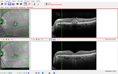 Pattern Dystrophy with Collapsed Vitelliform
74 year old female with vision loss in eye with collapsed vitelliform lesion.

