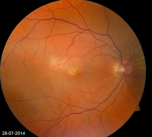 Photic Maculopathy Following Cataract Surgery
Initial images are from 1 week and subsequent images from 1 month post surgery.
