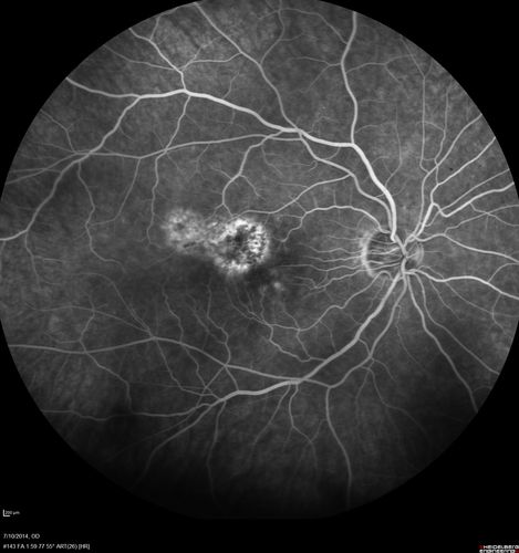 Photic Maculopathy Following Cataract Surgery
Initial images are from 1 week and subsequent images from 1 month post surgery.
