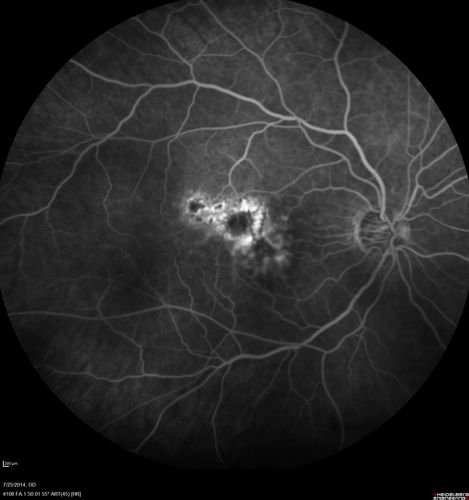 Photic Maculopathy Following Cataract Surgery
Initial images are from 1 week and subsequent images from 1 month post surgery.
