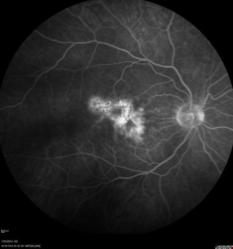 Photic Maculopathy Following Cataract Surgery
Initial images are from 1 week and subsequent images from 1 month post surgery.
