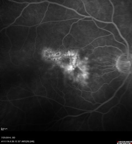 Photic Maculopathy Following Cataract Surgery
Initial images are from 1 week and subsequent images from 1 month post surgery.
