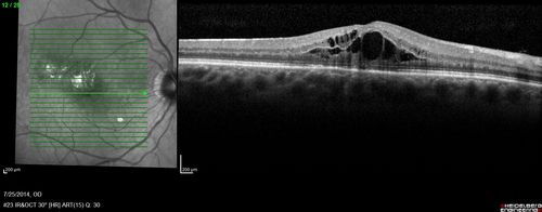 Photic Maculopathy Following Cataract Surgery
Initial images are from 1 week and subsequent images from 1 month post surgery.
