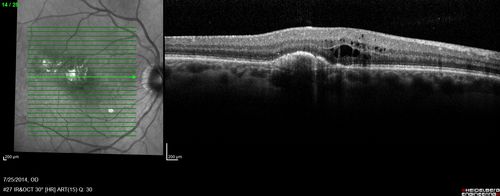 Photic Maculopathy Following Cataract Surgery
Initial images are from 1 week and subsequent images from 1 month post surgery.
