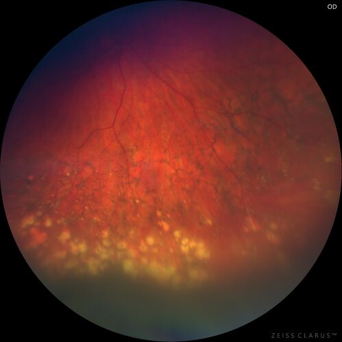 Peripheral reticular pigment degeneration - pavingstone degeneration - age-related macular degeneration
60 year old healthy man with intermediate AMD and peripheral pigment degeneration and pavinstone degeneration.  Vision is 20/20 OU and the patient is asymptomatic.  No significant history of AMD and he is a non-smoker.
