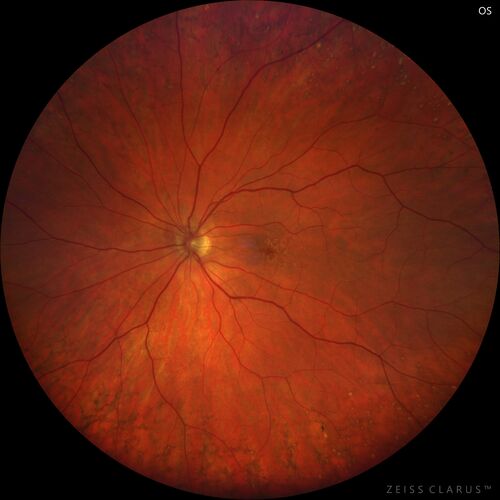 Peripheral reticular pigment degeneration - pavingstone degeneration - age-related macular degeneration
60 year old healthy man with intermediate AMD and peripheral pigment degeneration and pavinstone degeneration.  Vision is 20/20 OU and the patient is asymptomatic.  No significant history of AMD and he is a non-smoker.
