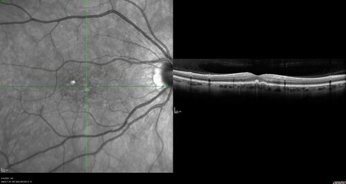 Peripheral reticular pigment degeneration - pavingstone degeneration - age-related macular degeneration
60 year old healthy man with intermediate AMD and peripheral pigment degeneration and pavinstone degeneration.  Vision is 20/20 OU and the patient is asymptomatic.  No significant history of AMD and he is a non-smoker.
