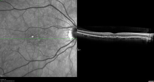 Peripheral reticular pigment degeneration - pavingstone degeneration - age-related macular degeneration
60 year old healthy man with intermediate AMD and peripheral pigment degeneration and pavinstone degeneration.  Vision is 20/20 OU and the patient is asymptomatic.  No significant history of AMD and he is a non-smoker.
