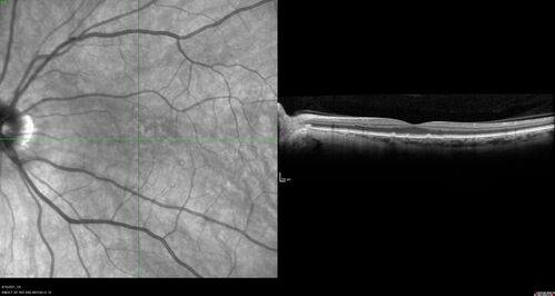 Peripheral reticular pigment degeneration - pavingstone degeneration - age-related macular degeneration
60 year old healthy man with intermediate AMD and peripheral pigment degeneration and pavinstone degeneration.  Vision is 20/20 OU and the patient is asymptomatic.  No significant history of AMD and he is a non-smoker.

