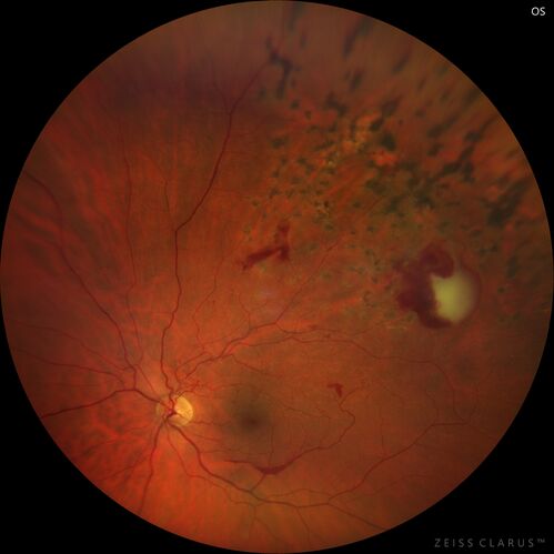 Branch Retinal Vein Occlusion with Neovascularization Elsewhere and Vitreous Hemorrhage - 1 month post laser
57 year old man New floaters in the left eye about a month ago.  Now they are getting better.  PMHx A-Fib on Pradaxa
VA 20/32 OD, 20/40 OS
1+ NS OU
BP 137/77, 200LBs, 5â€™8â€

PRP laser was done
