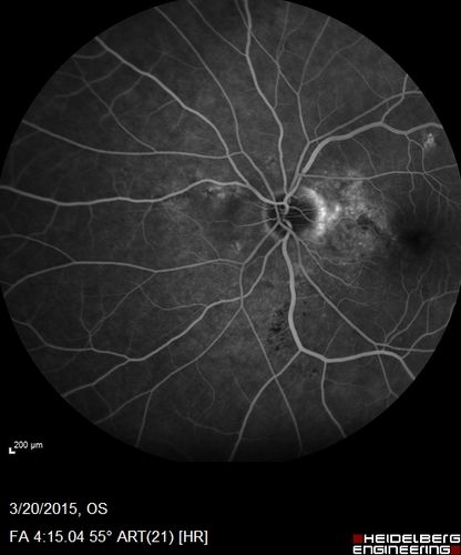 Posterior Uveal Effusion
