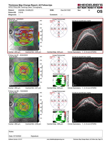 Wet AMD - Type 1 CNVM - RAP lesion
92 year old man with vision loss and very high PED.  Because of worry about a PED tear, patient was treated with avastin, then lucentis, then eyelea, then vabysmo (progressively stronger meds)
