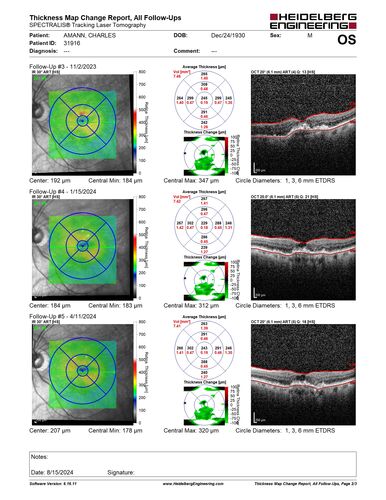 Wet AMD - Type 1 CNVM - RAP lesion
92 year old man with vision loss and very high PED.  Because of worry about a PED tear, patient was treated with avastin, then lucentis, then eyelea, then vabysmo (progressively stronger meds)
