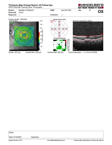 Wet AMD - Type 1 CNVM - RAP lesion
92 year old man with vision loss and very high PED.  Because of worry about a PED tear, patient was treated with avastin, then lucentis, then eyelea, then vabysmo (progressively stronger meds)
