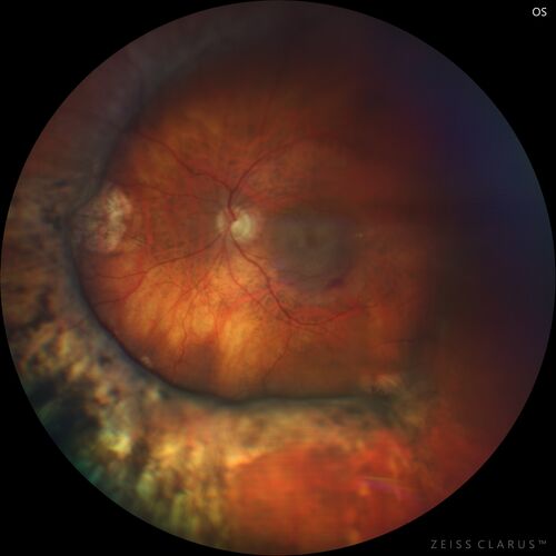 Wet AMD - Type 1 CNVM - RAP lesion
92 year old man with vision loss and very high PED.  Because of worry about a PED tear, patient was treated with avastin, then lucentis, then eyelea, then vabysmo (progressively stronger meds)

