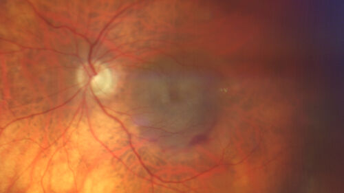 Wet AMD - Type 1 CNVM - RAP lesion
92 year old man with vision loss and very high PED.  Because of worry about a PED tear, patient was treated with avastin, then lucentis, then eyelea, then vabysmo (progressively stronger meds)
