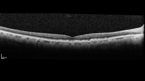 Wet AMD - Type 1 CNVM - RAP lesion
92 year old man with vision loss and very high PED.  Because of worry about a PED tear, patient was treated with avastin, then lucentis, then eyelea, then vabysmo (progressively stronger meds)
