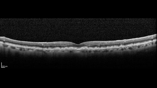 Wet AMD - Type 1 CNVM - RAP lesion
92 year old man with vision loss and very high PED.  Because of worry about a PED tear, patient was treated with avastin, then lucentis, then eyelea, then vabysmo (progressively stronger meds)
