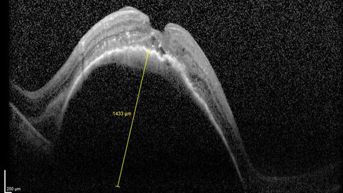 Wet AMD - Type 1 CNVM - RAP lesion
92 year old man with vision loss and very high PED.  Because of worry about a PED tear, patient was treated with avastin, then lucentis, then eyelea, then vabysmo (progressively stronger meds)

