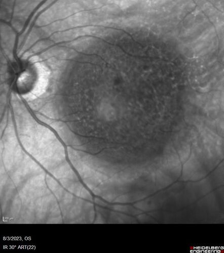 Wet AMD - Type 1 CNVM - RAP lesion
92 year old man with vision loss and very high PED.  Because of worry about a PED tear, patient was treated with avastin, then lucentis, then eyelea, then vabysmo (progressively stronger meds)
