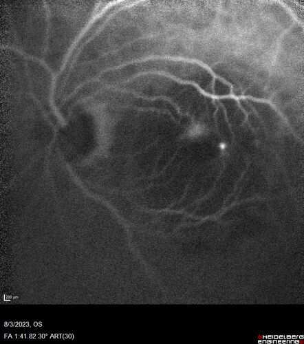 Wet AMD - Type 1 CNVM - RAP lesion
92 year old man with vision loss and very high PED.  Because of worry about a PED tear, patient was treated with avastin, then lucentis, then eyelea, then vabysmo (progressively stronger meds)
