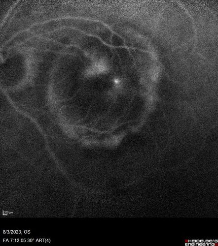 Wet AMD - Type 1 CNVM - RAP lesion
92 year old man with vision loss and very high PED.  Because of worry about a PED tear, patient was treated with avastin, then lucentis, then eyelea, then vabysmo (progressively stronger meds)
