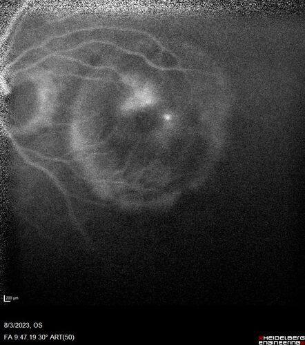 Wet AMD - Type 1 CNVM - RAP lesion
92 year old man with vision loss and very high PED.  Because of worry about a PED tear, patient was treated with avastin, then lucentis, then eyelea, then vabysmo (progressively stronger meds)
