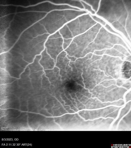Wet AMD - Type 1 CNVM - RAP lesion
92 year old man with vision loss and very high PED.  Because of worry about a PED tear, patient was treated with avastin, then lucentis, then eyelea, then vabysmo (progressively stronger meds)
