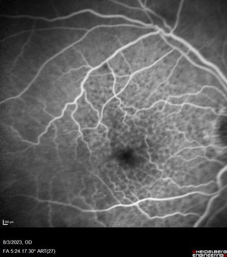 Wet AMD - Type 1 CNVM - RAP lesion
92 year old man with vision loss and very high PED.  Because of worry about a PED tear, patient was treated with avastin, then lucentis, then eyelea, then vabysmo (progressively stronger meds)
