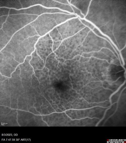 Wet AMD - Type 1 CNVM - RAP lesion
92 year old man with vision loss and very high PED.  Because of worry about a PED tear, patient was treated with avastin, then lucentis, then eyelea, then vabysmo (progressively stronger meds)
