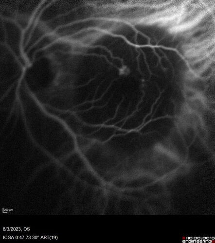 Wet AMD - Type 1 CNVM - RAP lesion
92 year old man with vision loss and very high PED.  Because of worry about a PED tear, patient was treated with avastin, then lucentis, then eyelea, then vabysmo (progressively stronger meds)
