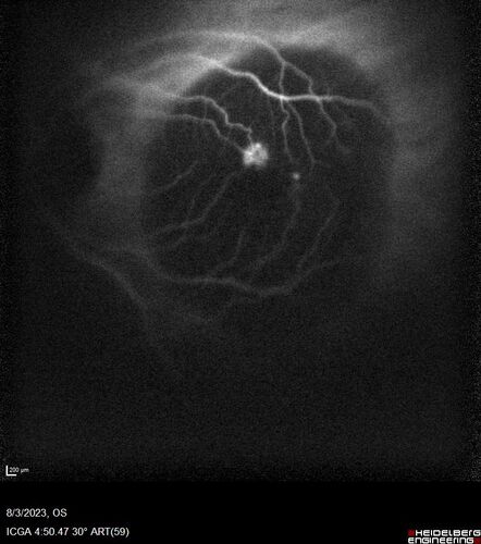 Wet AMD - Type 1 CNVM - RAP lesion
92 year old man with vision loss and very high PED.  Because of worry about a PED tear, patient was treated with avastin, then lucentis, then eyelea, then vabysmo (progressively stronger meds)
