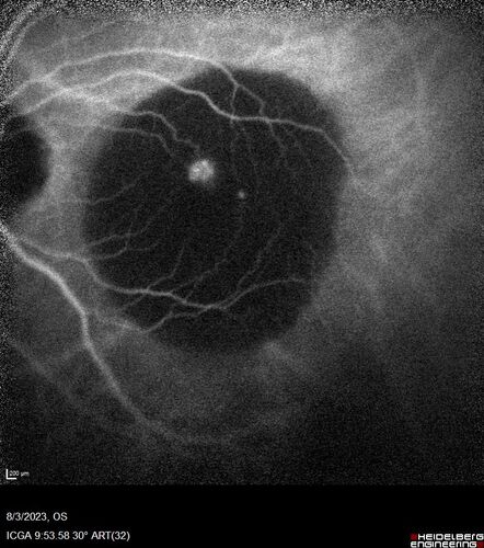 Wet AMD - Type 1 CNVM - RAP lesion
92 year old man with vision loss and very high PED.  Because of worry about a PED tear, patient was treated with avastin, then lucentis, then eyelea, then vabysmo (progressively stronger meds)
