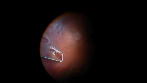 RD_diathermy.jpg