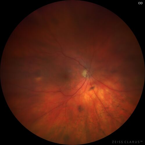 Retinal detachment with choroidal effusions and RPE tear
83 year old man with chronic glaucoma presented with 10 days of vision loss in the left eye and a retinal detachment.  He also has choroidal effusions and and RPE tear.  He had a history of bladder cancer in remission.  I did a biopsy of the choroidal lesions at the time of surgery which showed no cancer.  Initial vision was HM and final vision was 20/80.  The choroidal effusions may have occurred because of his age and prior history of glaucoma.

