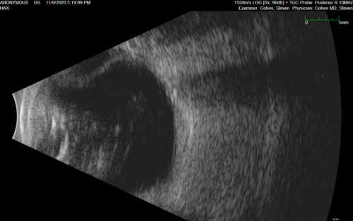 Retinal detachment with choroidal effusions and RPE tear
83 year old man with chronic glaucoma presented with 10 days of vision loss in the left eye and a retinal detachment.  He also has choroidal effusions and and RPE tear.  He had a history of bladder cancer in remission.  I did a biopsy of the choroidal lesions at the time of surgery which showed no cancer.  Initial vision was HM and final vision was 20/80.  The choroidal effusions may have occurred because of his age and prior history of glaucoma.
