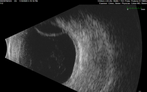 Retinal detachment with choroidal effusions and RPE tear
83 year old man with chronic glaucoma presented with 10 days of vision loss in the left eye and a retinal detachment.  He also has choroidal effusions and and RPE tear.  He had a history of bladder cancer in remission.  I did a biopsy of the choroidal lesions at the time of surgery which showed no cancer.  Initial vision was HM and final vision was 20/80.  The choroidal effusions may have occurred because of his age and prior history of glaucoma.
