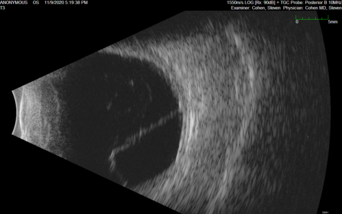 Retinal detachment with choroidal effusions and RPE tear
83 year old man with chronic glaucoma presented with 10 days of vision loss in the left eye and a retinal detachment.  He also has choroidal effusions and and RPE tear.  He had a history of bladder cancer in remission.  I did a biopsy of the choroidal lesions at the time of surgery which showed no cancer.  Initial vision was HM and final vision was 20/80.  The choroidal effusions may have occurred because of his age and prior history of glaucoma.
