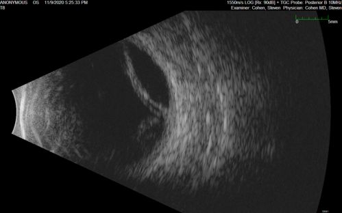 Retinal detachment with choroidal effusions and RPE tear
83 year old man with chronic glaucoma presented with 10 days of vision loss in the left eye and a retinal detachment.  He also has choroidal effusions and and RPE tear.  He had a history of bladder cancer in remission.  I did a biopsy of the choroidal lesions at the time of surgery which showed no cancer.  Initial vision was HM and final vision was 20/80.  The choroidal effusions may have occurred because of his age and prior history of glaucoma.
