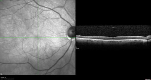 Retinal detachment with choroidal effusions and RPE tear
83 year old man with chronic glaucoma presented with 10 days of vision loss in the left eye and a retinal detachment.  He also has choroidal effusions and and RPE tear.  He had a history of bladder cancer in remission.  I did a biopsy of the choroidal lesions at the time of surgery which showed no cancer.  Initial vision was HM and final vision was 20/80.  The choroidal effusions may have occurred because of his age and prior history of glaucoma.
