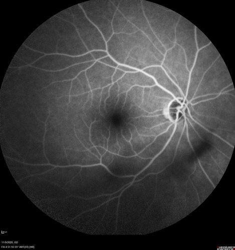 Retinal detachment with choroidal effusions and RPE tear
83 year old man with chronic glaucoma presented with 10 days of vision loss in the left eye and a retinal detachment.  He also has choroidal effusions and and RPE tear.  He had a history of bladder cancer in remission.  I did a biopsy of the choroidal lesions at the time of surgery which showed no cancer.  Initial vision was HM and final vision was 20/80.  The choroidal effusions may have occurred because of his age and prior history of glaucoma.
