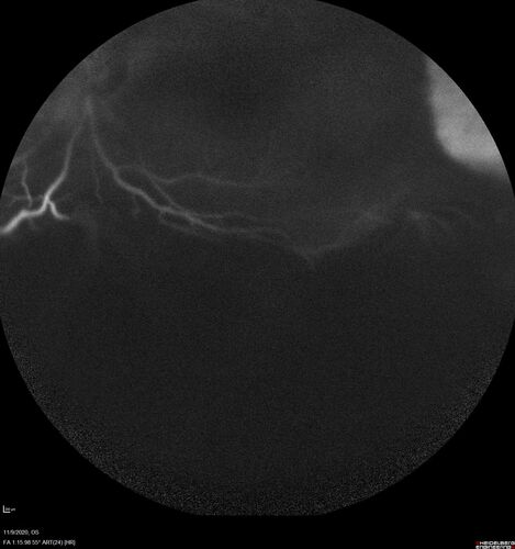 Retinal detachment with choroidal effusions and RPE tear
83 year old man with chronic glaucoma presented with 10 days of vision loss in the left eye and a retinal detachment.  He also has choroidal effusions and and RPE tear.  He had a history of bladder cancer in remission.  I did a biopsy of the choroidal lesions at the time of surgery which showed no cancer.  Initial vision was HM and final vision was 20/80.  The choroidal effusions may have occurred because of his age and prior history of glaucoma.
