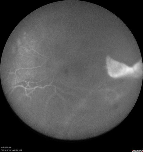 Retinal detachment with choroidal effusions and RPE tear
83 year old man with chronic glaucoma presented with 10 days of vision loss in the left eye and a retinal detachment.  He also has choroidal effusions and and RPE tear.  He had a history of bladder cancer in remission.  I did a biopsy of the choroidal lesions at the time of surgery which showed no cancer.  Initial vision was HM and final vision was 20/80.  The choroidal effusions may have occurred because of his age and prior history of glaucoma.
