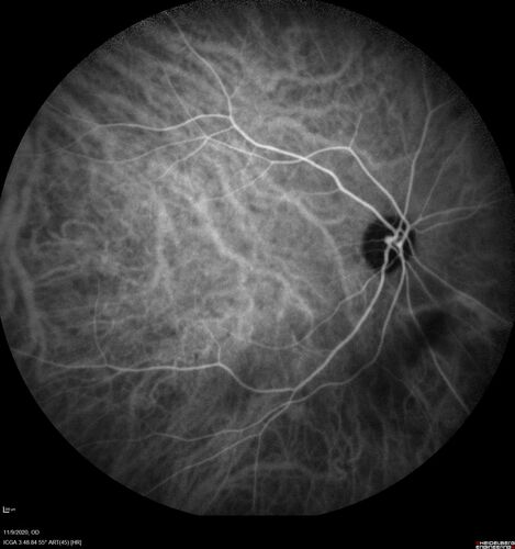 Retinal detachment with choroidal effusions and RPE tear
83 year old man with chronic glaucoma presented with 10 days of vision loss in the left eye and a retinal detachment.  He also has choroidal effusions and and RPE tear.  He had a history of bladder cancer in remission.  I did a biopsy of the choroidal lesions at the time of surgery which showed no cancer.  Initial vision was HM and final vision was 20/80.  The choroidal effusions may have occurred because of his age and prior history of glaucoma.
