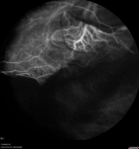 Retinal detachment with choroidal effusions and RPE tear
83 year old man with chronic glaucoma presented with 10 days of vision loss in the left eye and a retinal detachment.  He also has choroidal effusions and and RPE tear.  He had a history of bladder cancer in remission.  I did a biopsy of the choroidal lesions at the time of surgery which showed no cancer.  Initial vision was HM and final vision was 20/80.  The choroidal effusions may have occurred because of his age and prior history of glaucoma.
