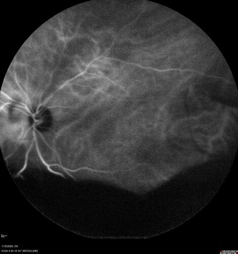 Retinal detachment with choroidal effusions and RPE tear
83 year old man with chronic glaucoma presented with 10 days of vision loss in the left eye and a retinal detachment.  He also has choroidal effusions and and RPE tear.  He had a history of bladder cancer in remission.  I did a biopsy of the choroidal lesions at the time of surgery which showed no cancer.  Initial vision was HM and final vision was 20/80.  The choroidal effusions may have occurred because of his age and prior history of glaucoma.
