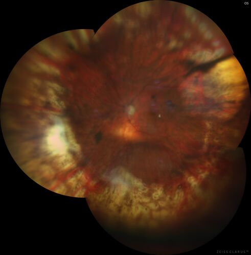 Retinal Detachment with Choroidal Effusion post-PPV-Buckle-Biopsy
The patient was 20/80 8 months post-op
