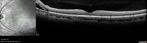 Asymptomatic progressing retinal detachment 27 year old man
This detachment was followed for one month, progressed, and was repaired with a scleral buckle.
