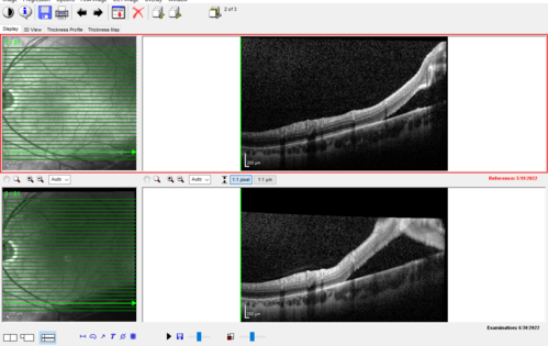 Asymptomatic progressing retinal detachment 27 year old man
This detachment was followed for one month, progressed, and was repaired with a scleral buckle.
